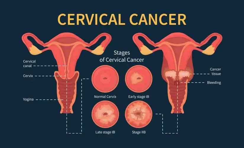 Cervical Cancer: Why We Count Years, Not Scars · Medical Guide by Famicare Speciality Center