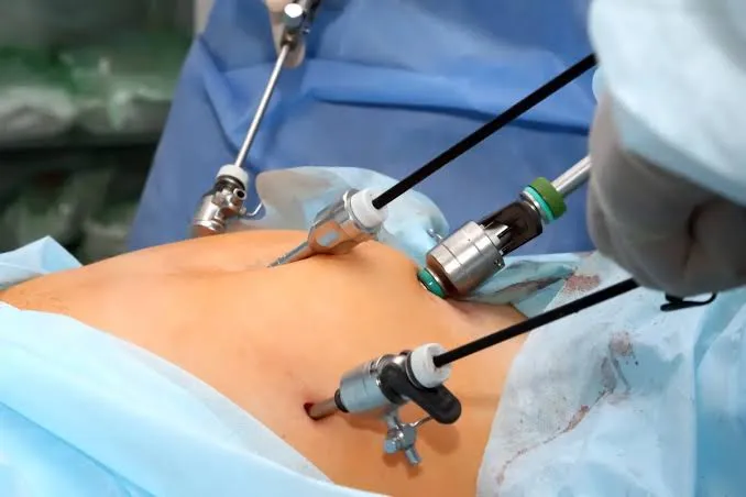 Recurrent and Ectopic Leiomyoma After Hysterectomy: The Critical Need for Cautious Laparoscopic Practice · Medical Guide by Famicare Speciality Center